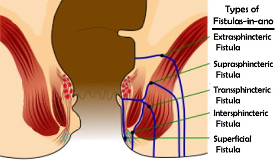 Types of Fistula-in-ano
